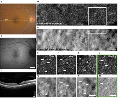 Persistent Dark Cones in Oligocone Trichromacy Revealed by Multimodal Adaptive Optics Ophthalmoscopy